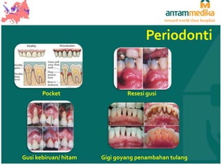 toward world class hospital

Periodonti

Pocket

Gusi kebiruan/ hitam

Resesi gusi

Gigi goyang penambahan tulang

 