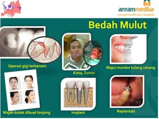 toward world class hospital

Bedah Mulut

Operasi gigi terbenam

Maju/ mundur tulang rahang
Kista, Tumor

Wajah kotak dibuat lonjong

Implant

Replantasi

 