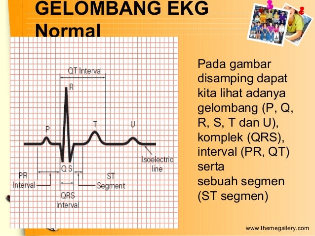 Unduh 91 Gambar Gelombang Ekg Normal  