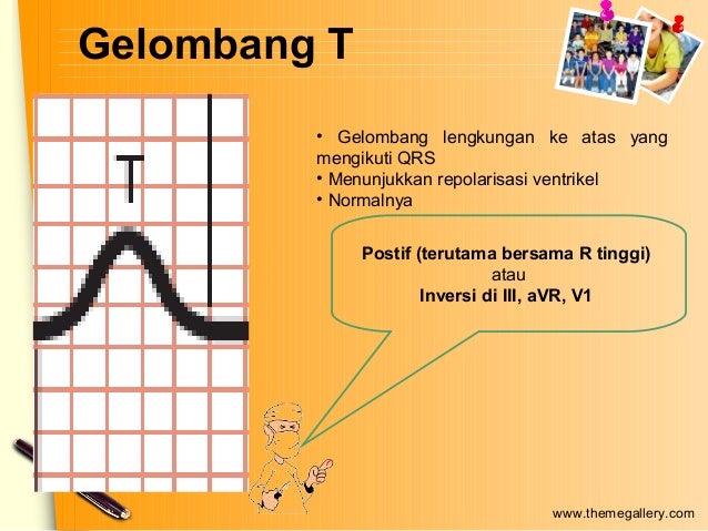 Unduh 91 Gambar Gelombang Ekg Normal  