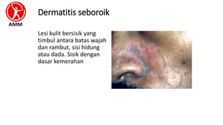 Dermatitis seboroik
Lesi kulit bersisik yang
timbul antara batas wajah
dan rambut, sisi hidung
atau dada. Sisik dengan
dasar kemerahan
 
