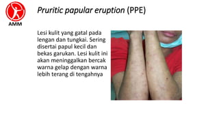 Pruritic papular eruption (PPE)
Lesi kulit yang gatal pada
lengan dan tungkai. Sering
disertai papul kecil dan
bekas garukan. Lesi kulit ini
akan meninggalkan bercak
warna gelap dengan warna
lebih terang di tengahnya
 