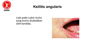 Keilitis angularis
Luka pada sudut mulut
yang kronis disebabkan
oleh kandida.
 