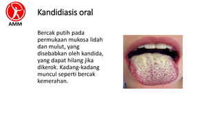 Kandidiasis oral
Bercak putih pada
permukaan mukosa lidah
dan mulut, yang
disebabkan oleh kandida,
yang dapat hilang jika
dikerok. Kadang-kadang
muncul seperti bercak
kemerahan.
 