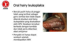 Oral hairy leukoplakia
• Bercak putih halus di pinggir
lidah yang terlihat sebagai
garis vertikal dan tidak dapat
dikerok disebut oral hairy
leukoplakia yang disebabkan
oleh HPV. Keadaan tersebut
berbeda dengan kandida
dan tidak perlu diberikan
obat antijamur
• Penyakit ini hanya dapat
sembuh setelah
mendapatkan ARV
 