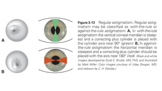 Compound Myopia Example Comprehensive Case Report on Compound Myopic Astigmatism Management and ...