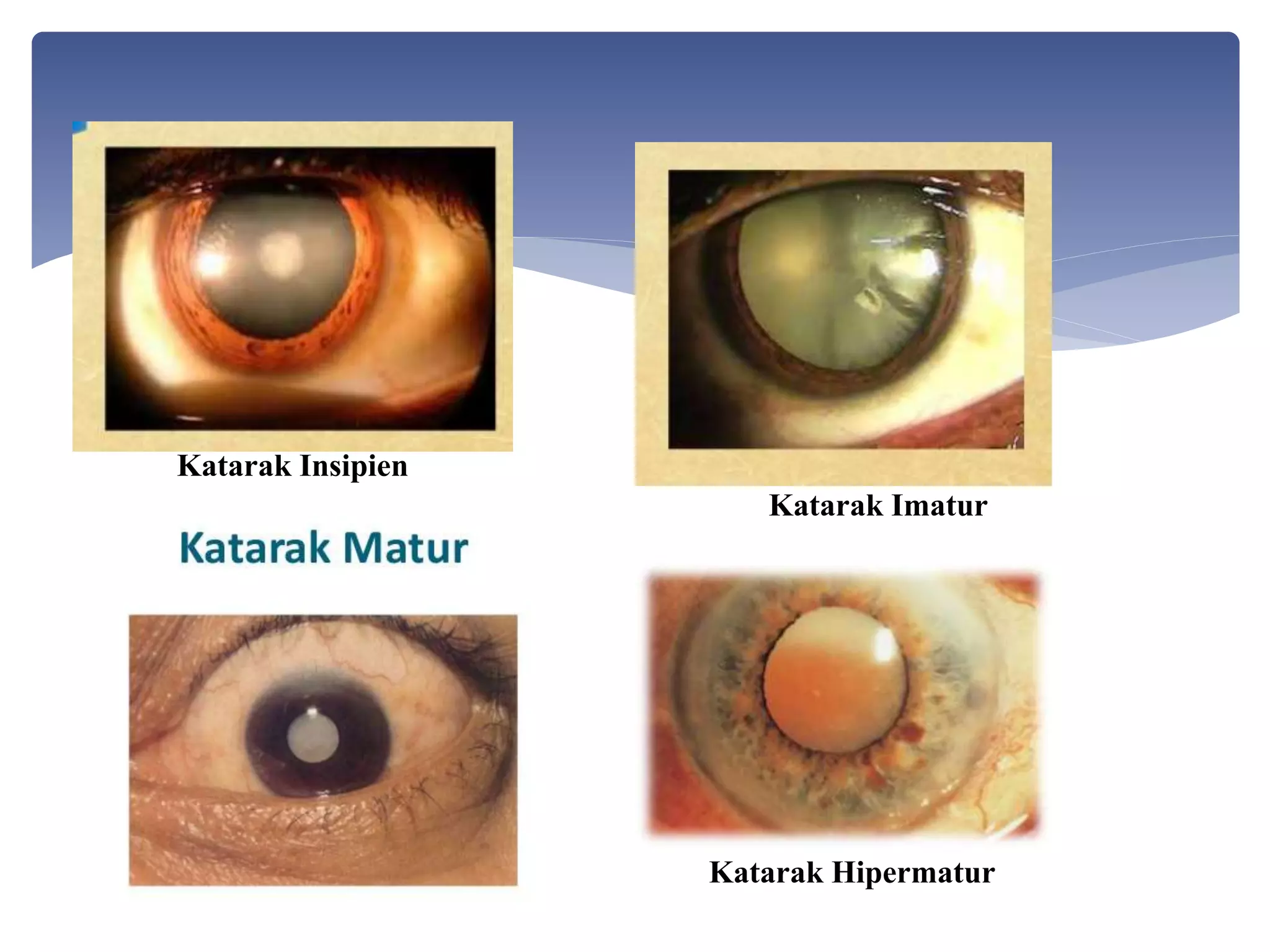  katara
Katarak Insipien
Katarak Imatur
Katarak Hipermatur