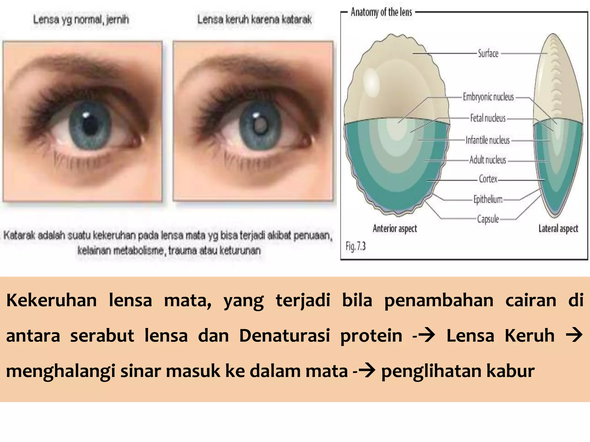 Kekeruhan lensa mata, yang terjadi bila penambahan cairan di
antara serabut lensa dan Denaturasi protein - Lensa Keruh
menghalangi sinar masuk ke dalam mata - penglihatan kabur