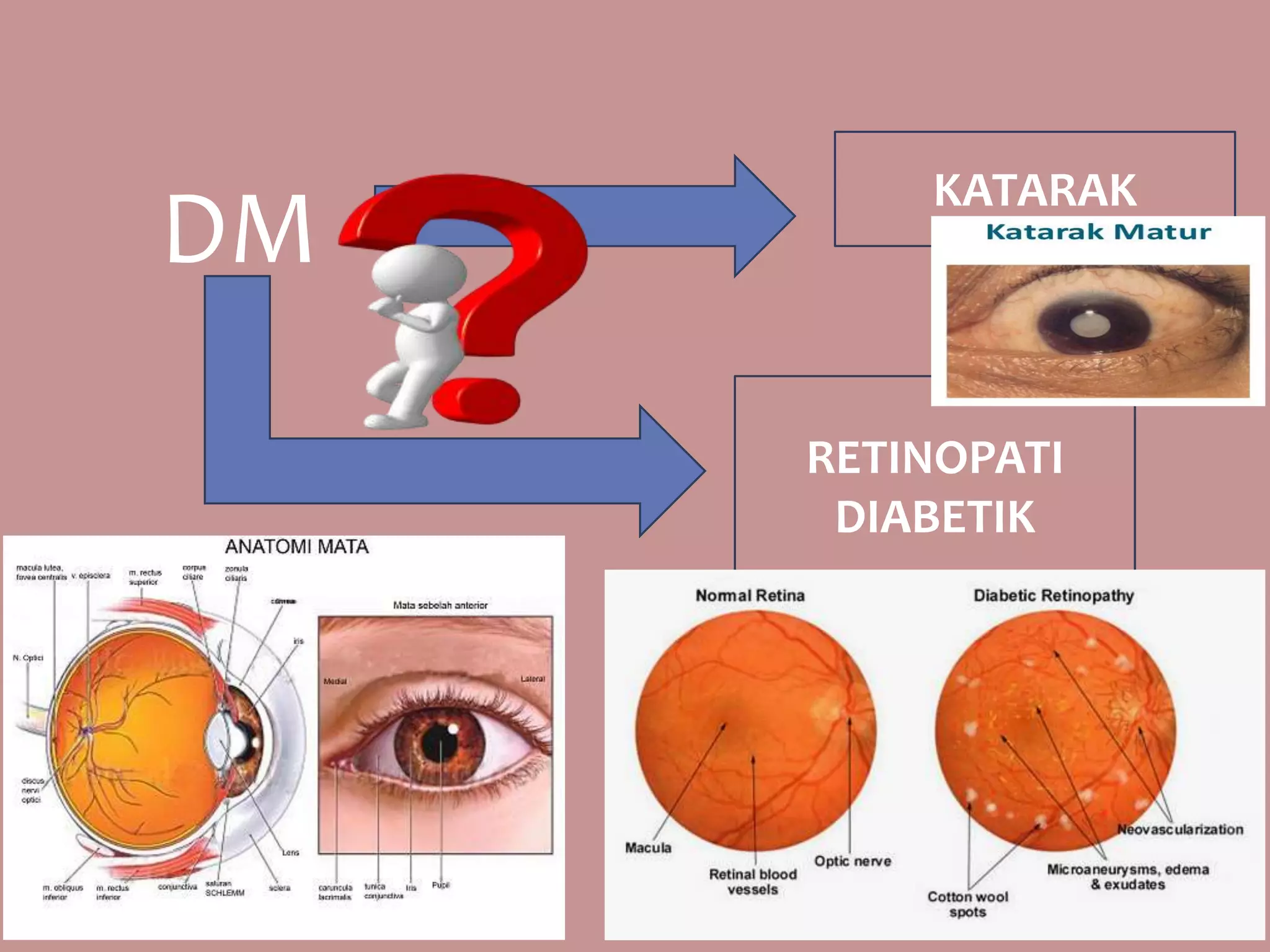 DM
KATARAK
RETINOPATI
DIABETIK