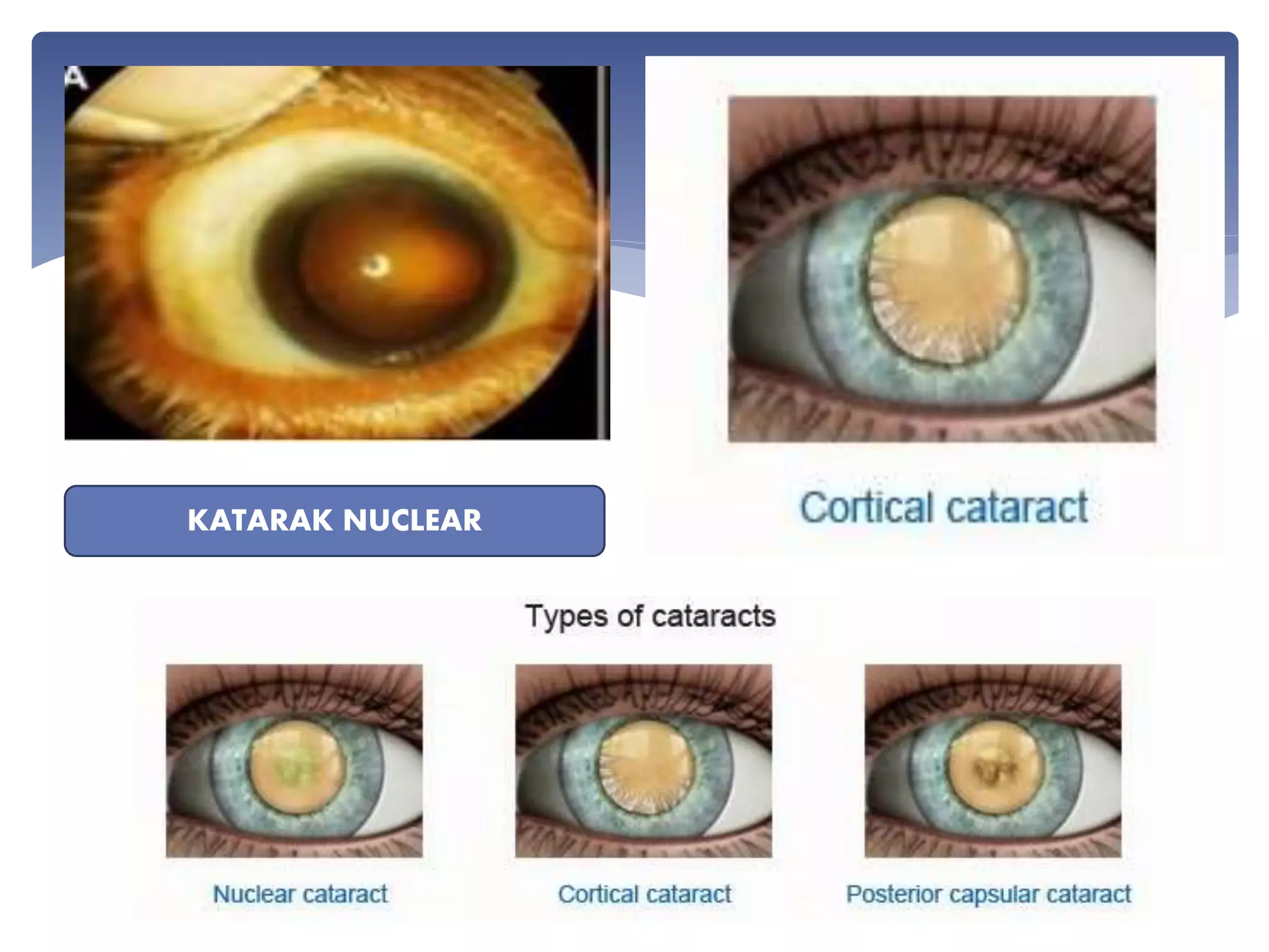 Katarak Nuklear
KATARAK NUCLEAR