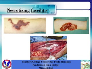 Necrotizing fascilitis
Teachers College Universitas Pelita Harapan
Pendidikan Ilmu Biologi
Mikrobiologi
 