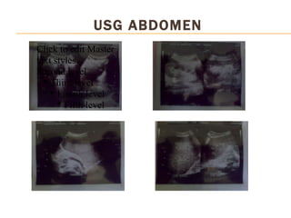 USG ABDOMEN Click to edit Master text styles Second level Third level Fourth level Fifth level 