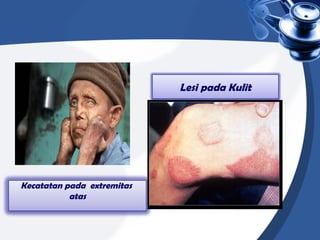 Lesi pada Kulit
Kecatatan pada extremitas
atas
 