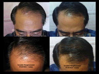 Sesudah Mengkonsumsi   Sesudah Mengkonsumsi
  PURTIER 1 bulan        PURTIER 6 bulan
 