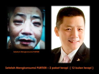 Sebelum Mengkonsumsi PURTIER




Setelah Mengkonsumsi PURTIER – 2 paket terapi ( 12 bulan terapi )
 