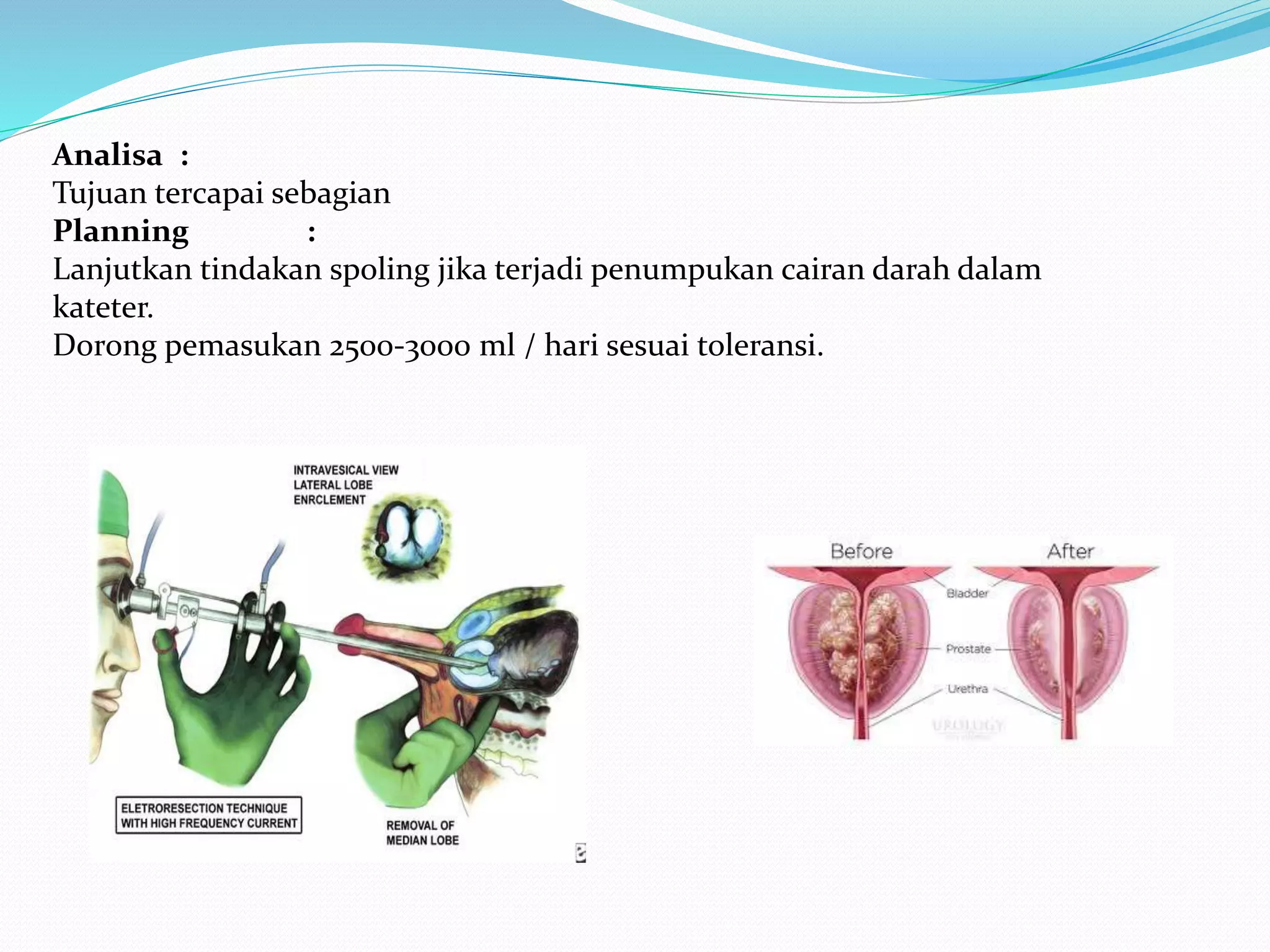 post op Tur-p | PPTX