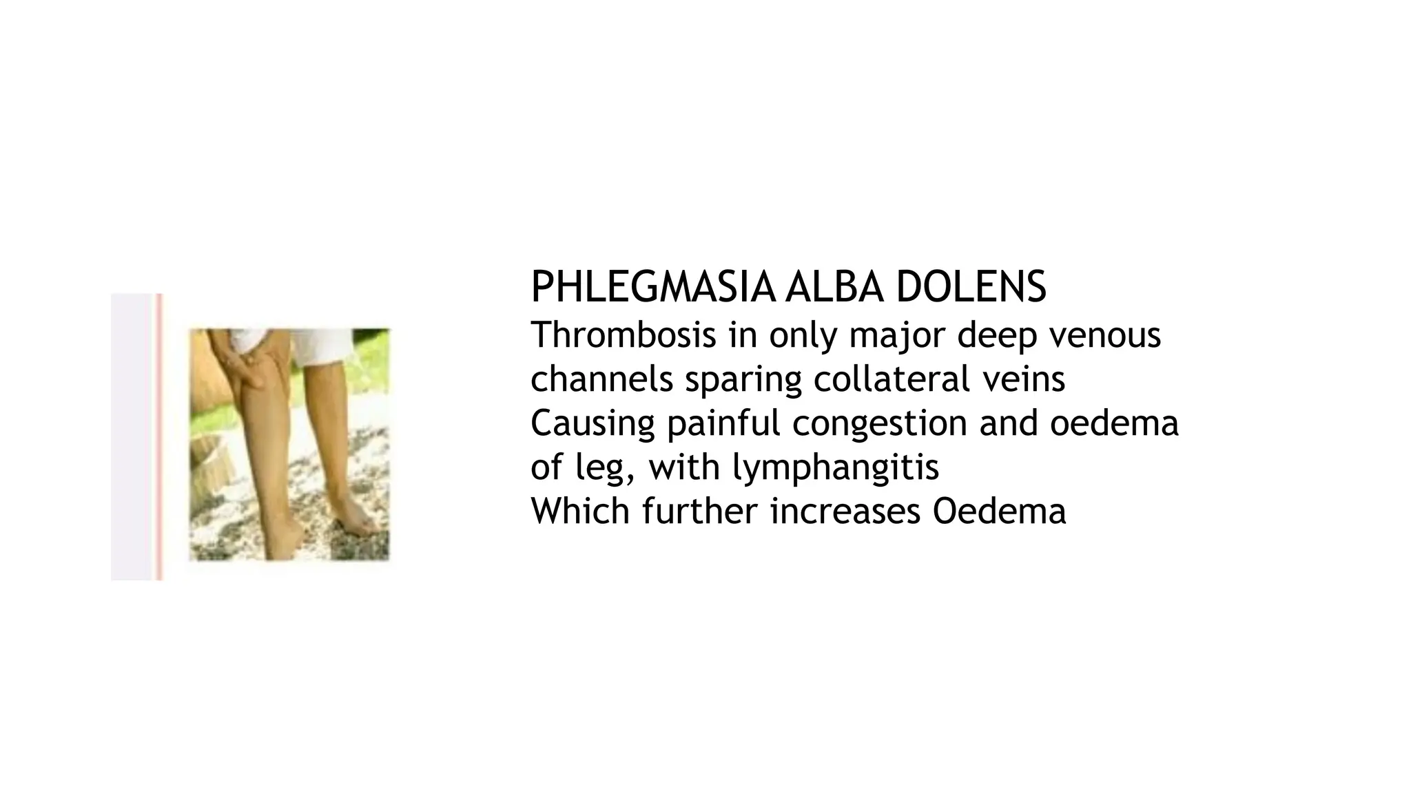 PHLEGMASIA ALBA DOLENS
Thrombosis in only major deep venous
channels sparing collateral veins
Causing painful congestion and oedema
of leg, with lymphangitis
Which further increases Oedema
 