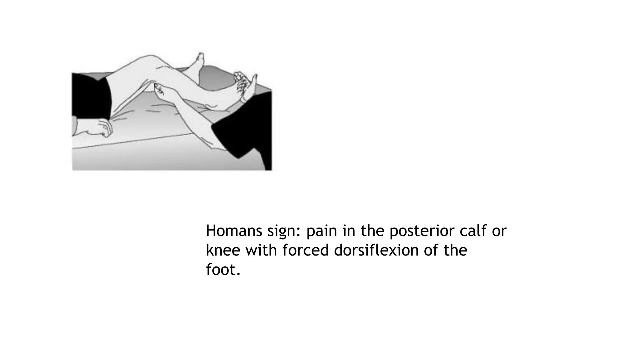 Homans sign: pain in the posterior calf or
knee with forced dorsiflexion of the
foot.
 
