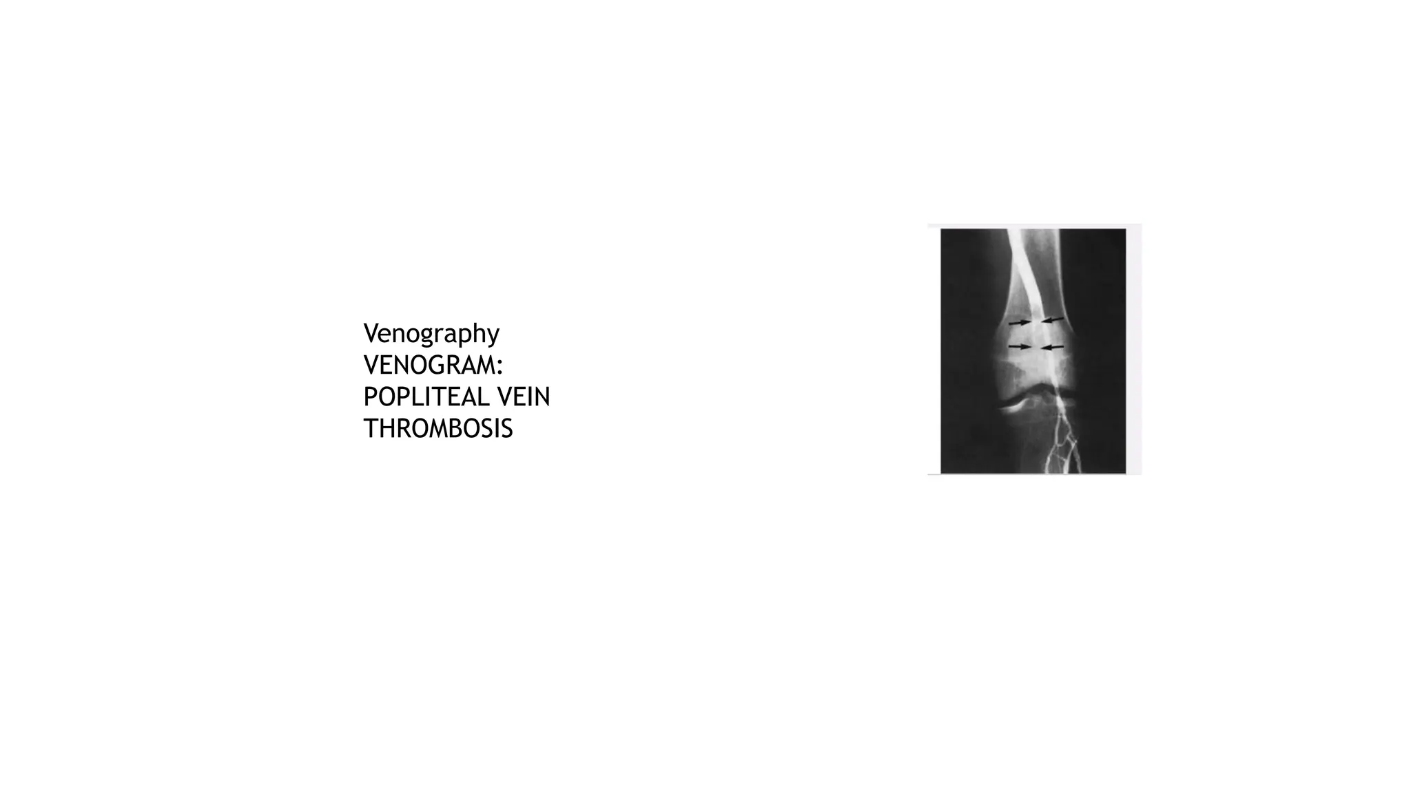 Venography
VENOGRAM:
POPLITEAL VEIN
THROMBOSIS
 