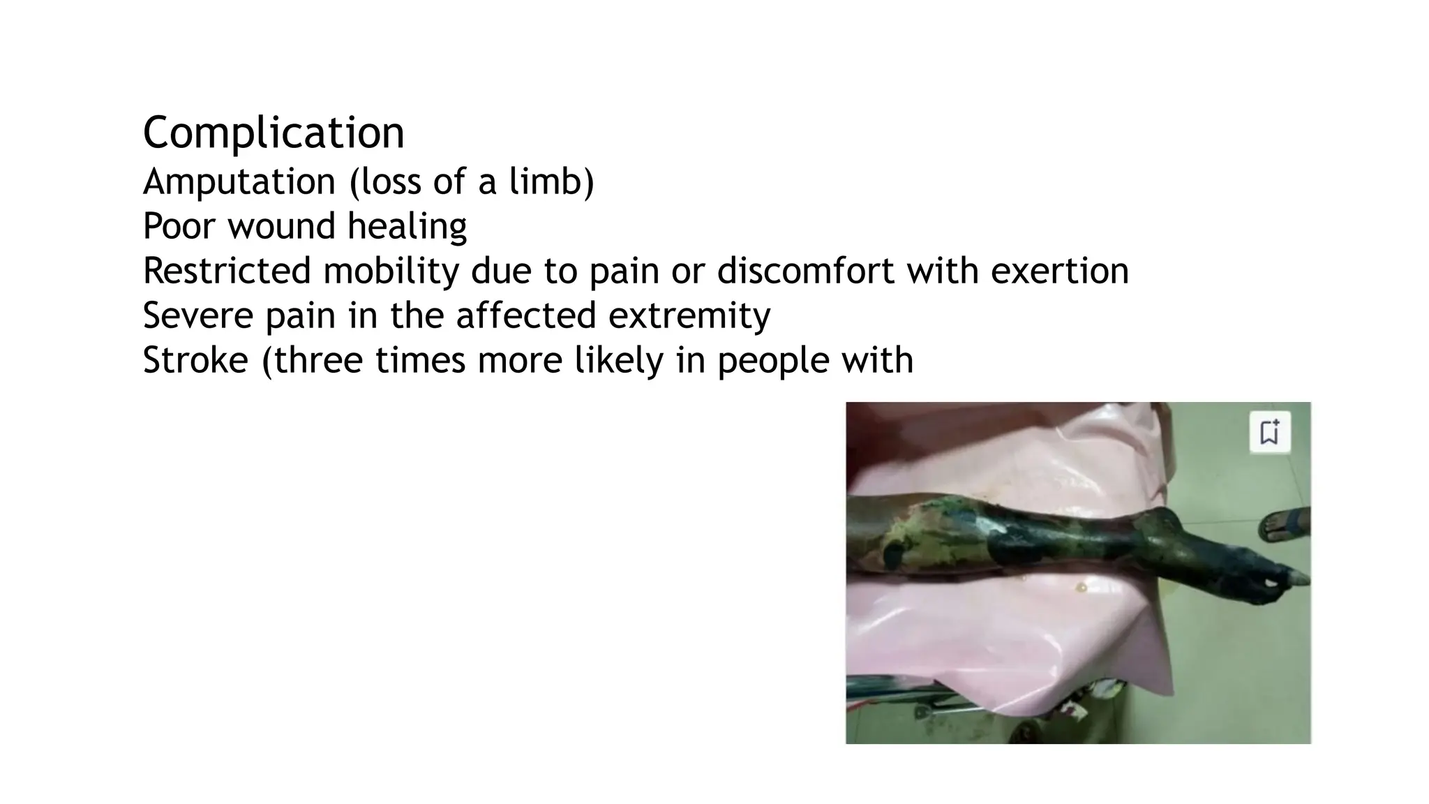 Complication
Amputation (loss of a limb)
Poor wound healing
Restricted mobility due to pain or discomfort with exertion
Severe pain in the affected extremity
Stroke (three times more likely in people with
 