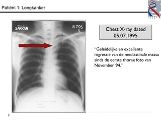 Patiënt 1: Longkanker



                              Chest X-ray dated
                                 05.07.1995

                        “Geleidelijke en excellente
                        regressie van de mediastinale massa
                        sinds de eerste thorax foto van
                        November „94.”
 