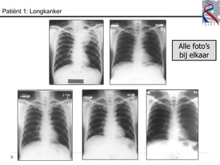 Patiënt 1: Longkanker




                        Alle foto’s
                        bij elkaar
 
