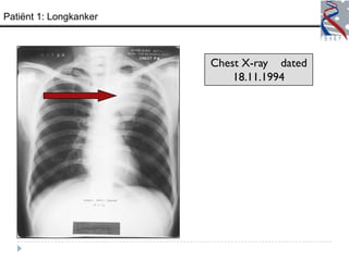 Patiënt 1: Longkanker



                        Chest X-ray dated
                            18.11.1994
 