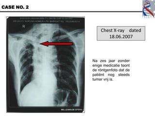 CASE NO. 2




                 Chest X-ray dated
                    18.06.2007



             Na zes jaar zonder
             enige medicatie toont
             de röntgenfoto dat de
             patiënt nog steeds
             tumor vrij is.
 