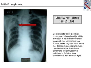 Patiënt2: longkanker.




                           Chest X-ray dated
                              18.12.1998



                        De thoraxfoto toont „Een niet
                        homogene holteonduidelijkheid is
                        zichtbaar in de rechter bovenste
                        longkwab met kenmerken van
                        fibrose, welke uitgroeit naar rechts
                        met daarbij de aanwezigheid van
                        cysteholtes bij de linker basis.
                        Bijkomend longemfyseem is
                        zichtbaar in de linker long.
                        Milde effusie aan de linker zijde.
 