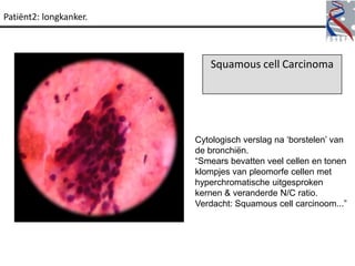 Patiënt2: longkanker.



                           Squamous cell Carcinoma




                        Cytologisch verslag na „borstelen‟ van
                        de bronchiën.
                        “Smears bevatten veel cellen en tonen
                        klompjes van pleomorfe cellen met
                        hyperchromatische uitgesproken
                        kernen & veranderde N/C ratio.
                        Verdacht: Squamous cell carcinoom...”
 