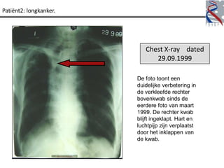 Patiënt2: longkanker.




                           Chest X-ray dated
                              29.09.1999

                        De foto toont een
                        duidelijke verbetering in
                        de verkleefde rechter
                        bovenkwab sinds de
                        eerdere foto van maart
                        1999. De rechter kwab
                        blijft ingeklapt. Hart en
                        luchtpijp zijn verplaatst
                        door het inklappen van
                        de kwab.
 