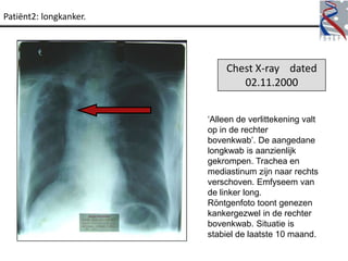 Patiënt2: longkanker.




                             Chest X-ray dated
                                02.11.2000


                        „Alleen de verlittekening valt
                        op in de rechter
                        bovenkwab‟. De aangedane
                        longkwab is aanzienlijk
                        gekrompen. Trachea en
                        mediastinum zijn naar rechts
                        verschoven. Emfyseem van
                        de linker long.
                        Röntgenfoto toont genezen
                        kankergezwel in de rechter
                        bovenkwab. Situatie is
                        stabiel de laatste 10 maand.
 