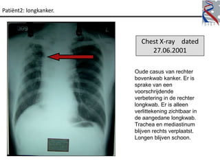 Patiënt2: longkanker.




                          Chest X-ray dated
                             27.06.2001

                        Oude casus van rechter
                        bovenkwab kanker. Er is
                        sprake van een
                        voorschrijdende
                        verbetering in de rechter
                        longkwab. Er is alleen
                        verlittekening zichtbaar in
                        de aangedane longkwab.
                        Trachea en mediastinum
                        blijven rechts verplaatst.
                        Longen blijven schoon.
 