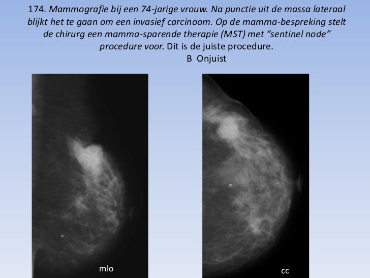 Presentatie mammovragen tbv vgt
