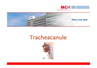 Tracheacanule
 