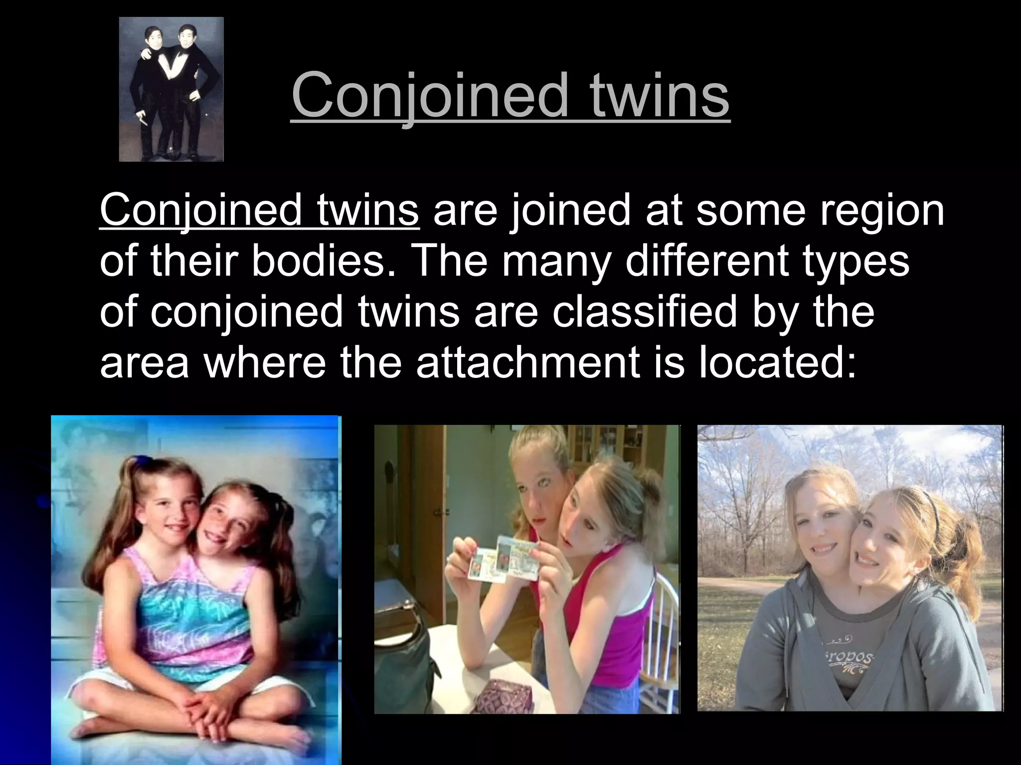 Conjoined twins Conjoined twins  are joined at some region of their bodies. The many different types of conjoined twins are classified by the area where the attachment is located: 