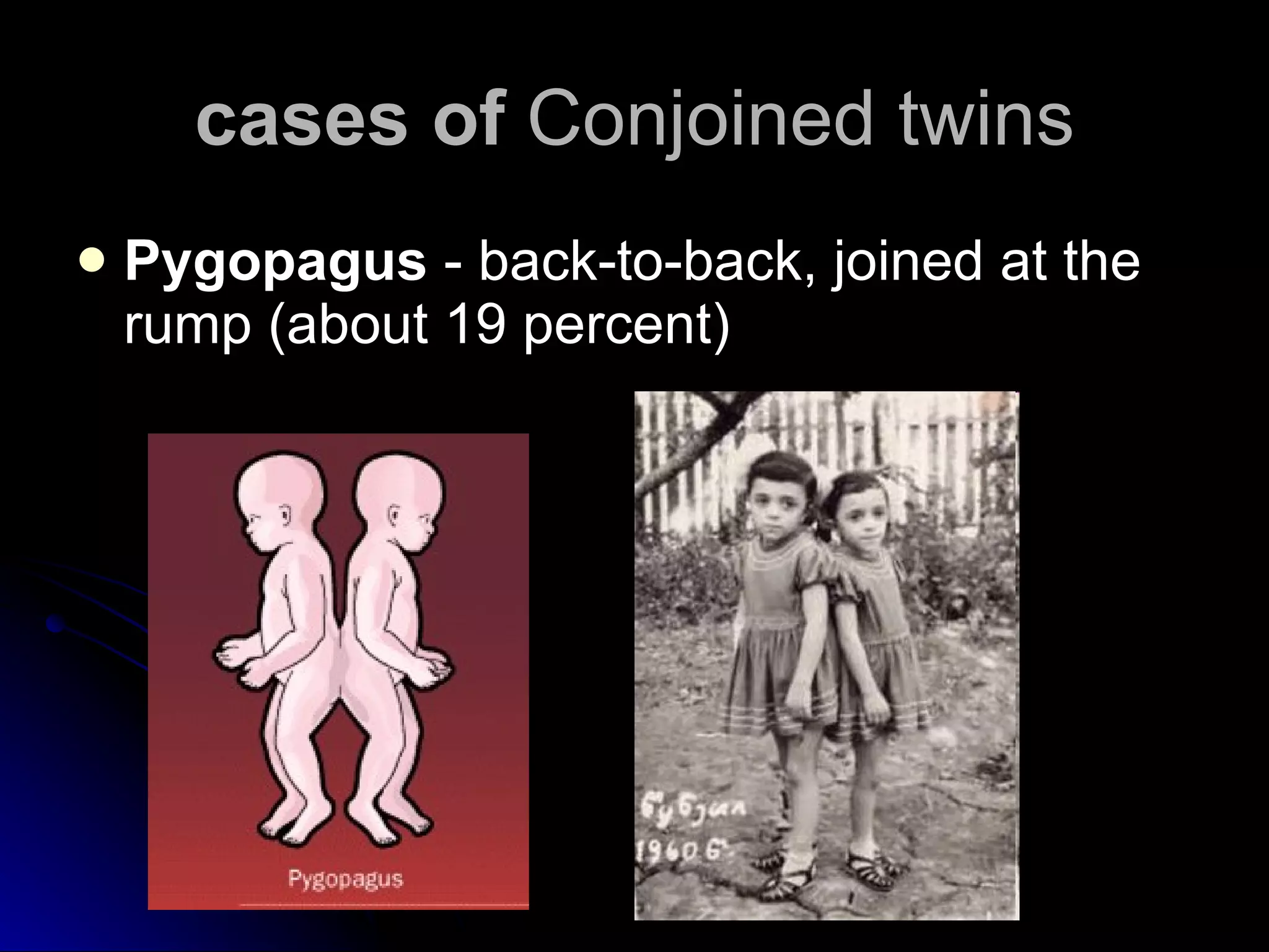 cases of  Conjoined twins Pygopagus  - back-to-back, joined at the rump (about 19 percent) 