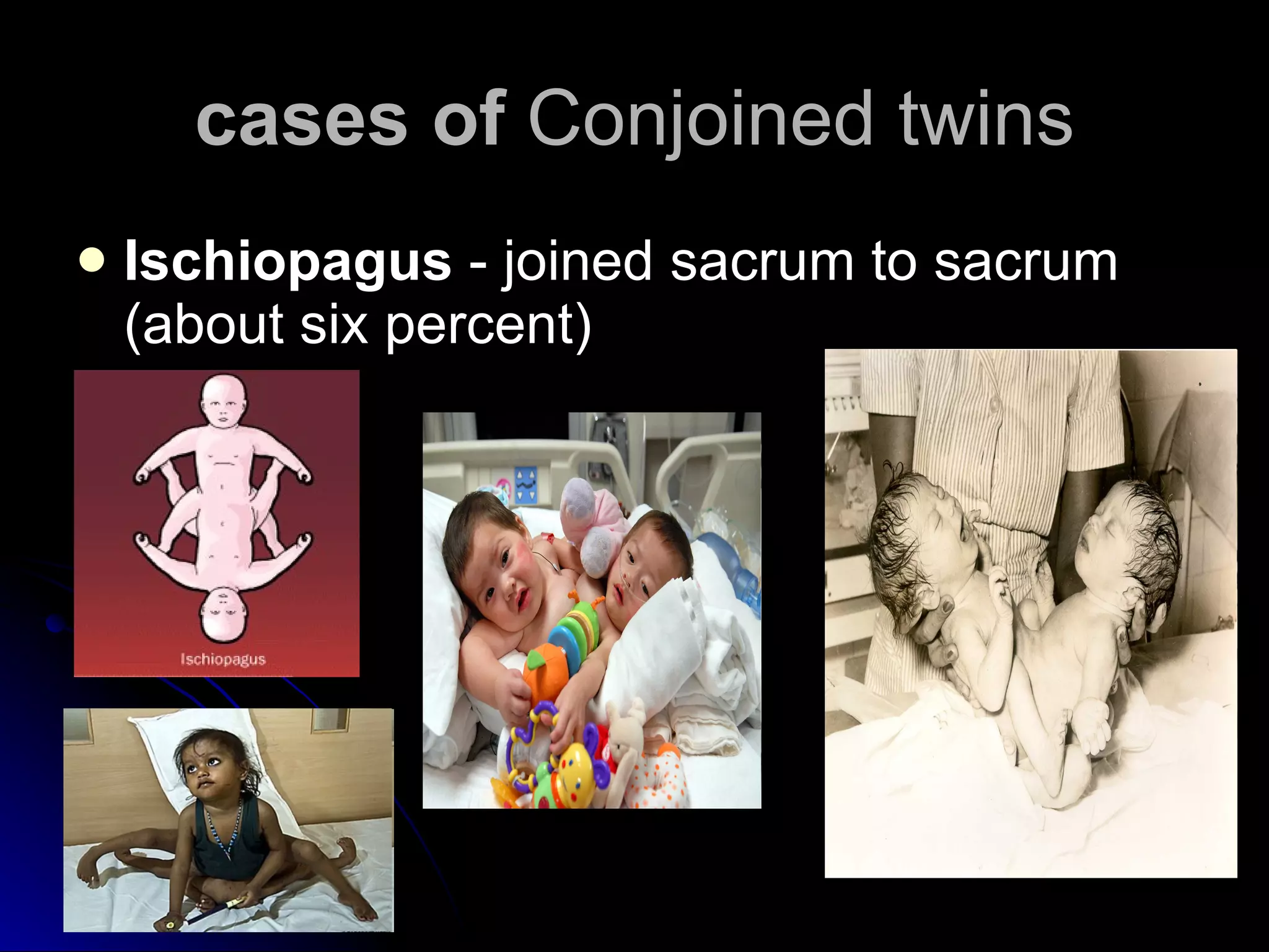 cases of  Conjoined twins Ischiopagus  - joined sacrum to sacrum (about six percent)  