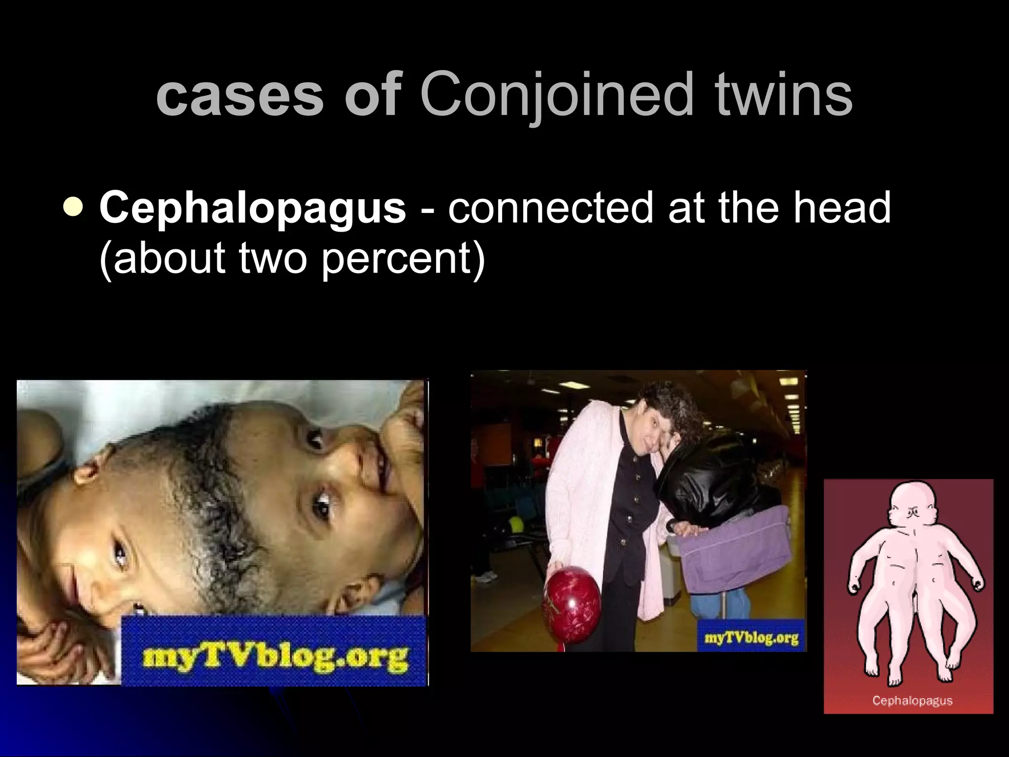 cases of  Conjoined twins Cephalopagus  - connected at the head (about two percent)  