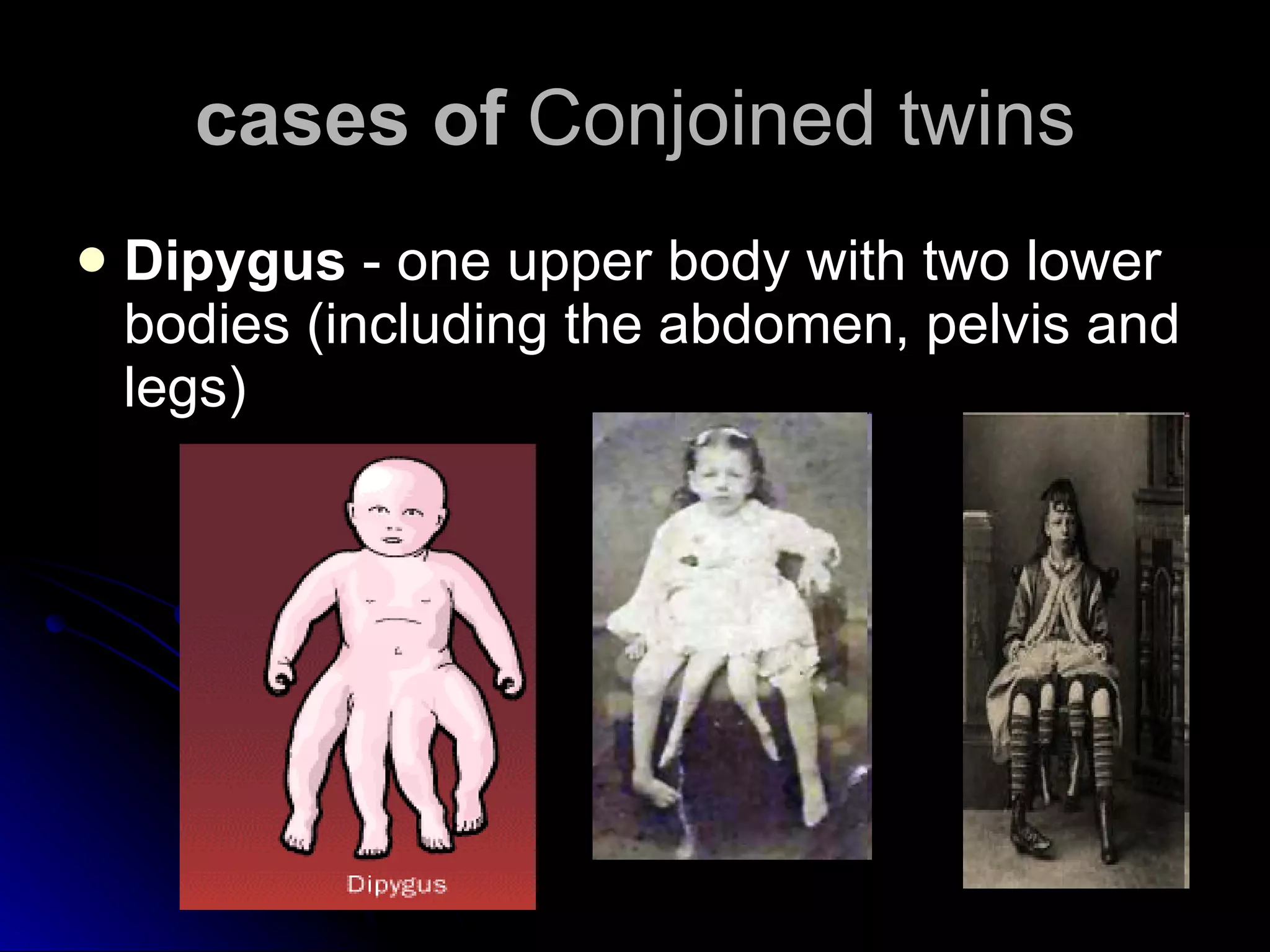 cases of  Conjoined twins Dipygus  - one upper body with two lower bodies (including the abdomen, pelvis and legs)  