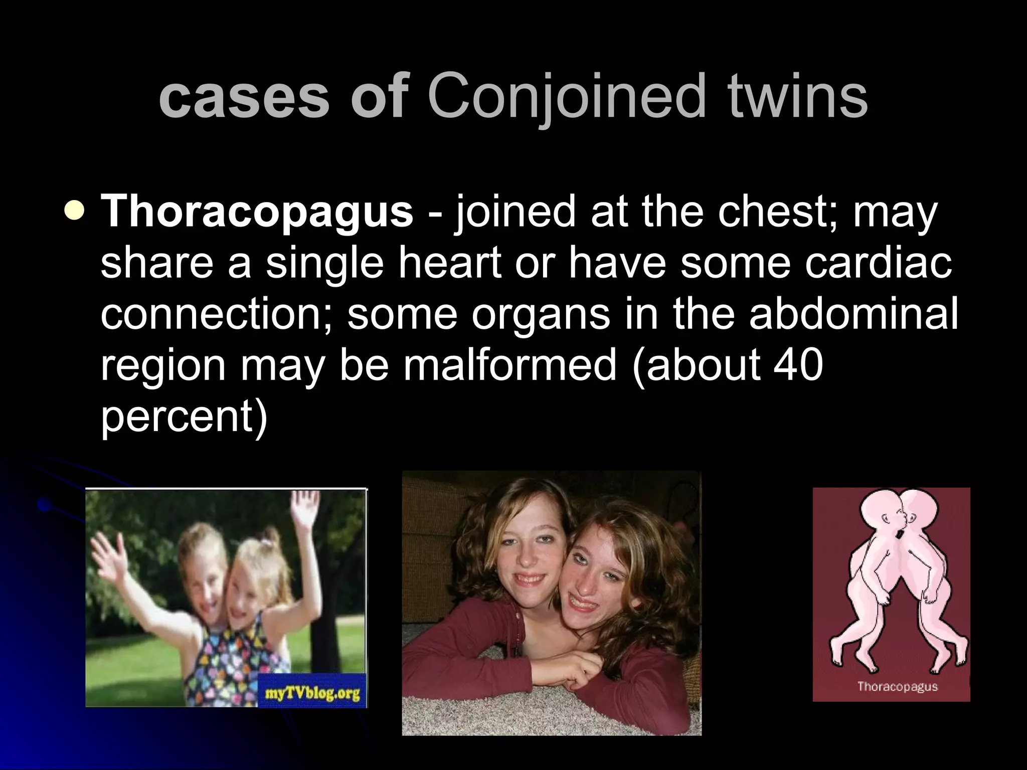 cases of  Conjoined twins Thoracopagus  - joined at the chest; may share a single heart or have some cardiac connection; some organs in the abdominal region may be malformed (about 40 percent)  