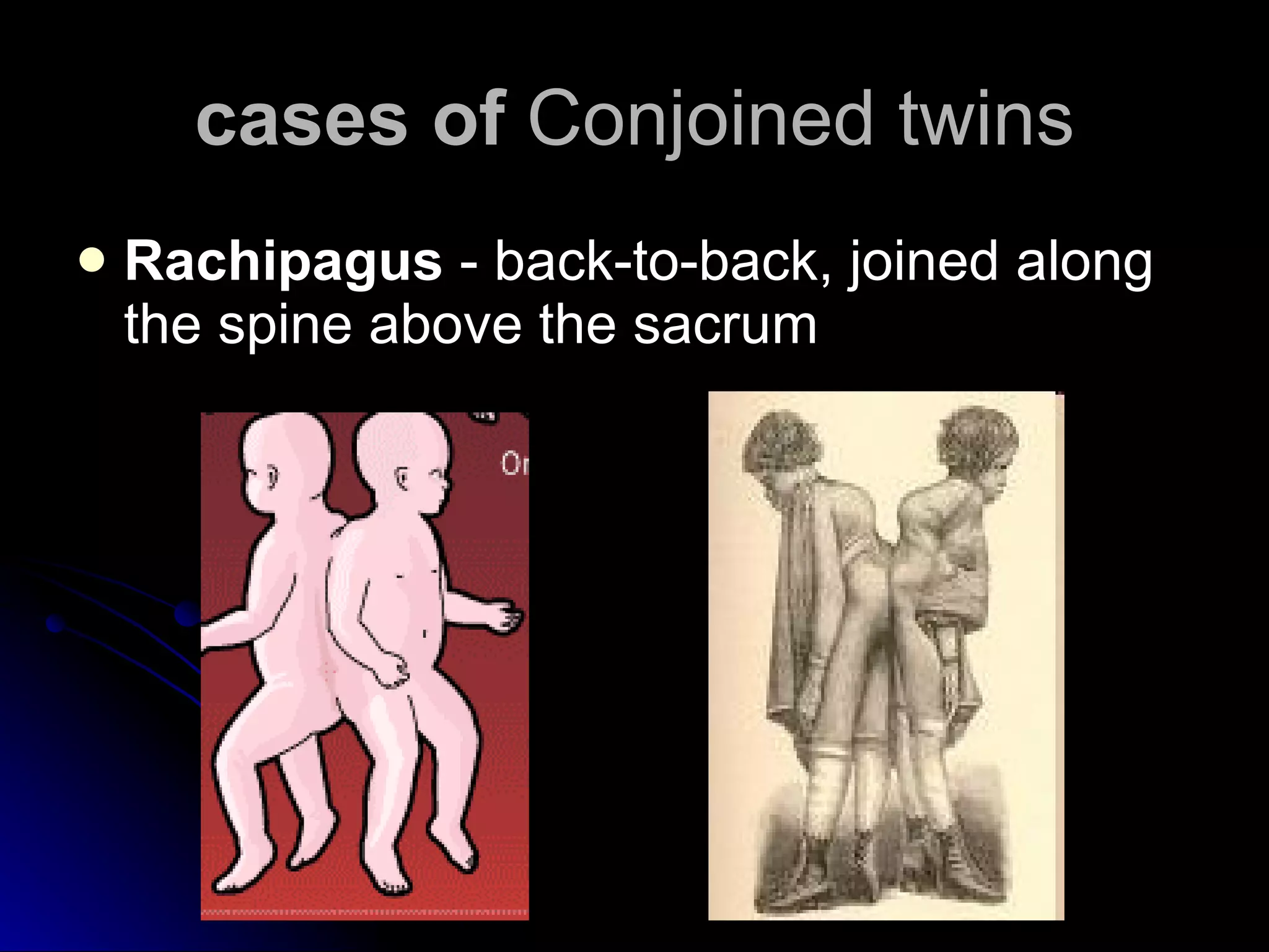 cases of  Conjoined twins Rachipagus  - back-to-back, joined along the spine above the sacrum  