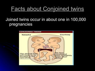 Facts about Conjoined twins Joined twins occur in about one in 100,000 pregnancies  