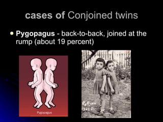 cases of  Conjoined twins Pygopagus  - back-to-back, joined at the rump (about 19 percent) 