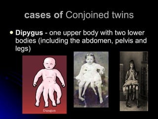 cases of  Conjoined twins Dipygus  - one upper body with two lower bodies (including the abdomen, pelvis and legs)  