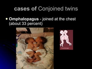 cases of  Conjoined twins Omphalopagus  - joined at the chest (about 33 percent)  