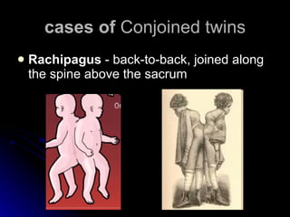 cases of  Conjoined twins Rachipagus  - back-to-back, joined along the spine above the sacrum  