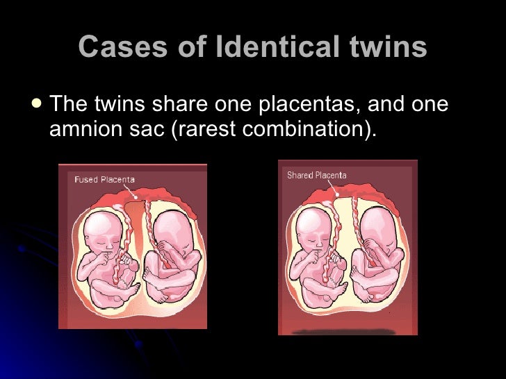 What Are The Twins And Basic Types identical-vs-fraternal-twins-ultrasound