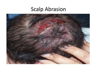 Scalp Abrasion
 