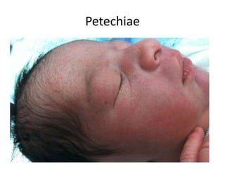 Petechiae
 